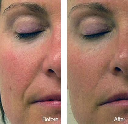 face rolling before and after|before and after facial roller.